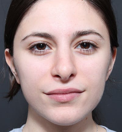 Rhinoplasty Before & After Gallery - Patient 14089516 - Image 4