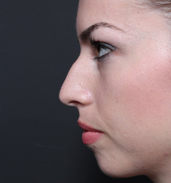 Rhinoplasty Before & After Gallery - Patient 14089517 - Image 5