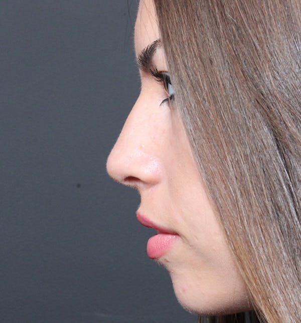 Rhinoplasty Before & After Gallery - Patient 14089517 - Image 6