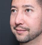 Rhinoplasty Before & After Gallery - Patient 14089519 - Image 2