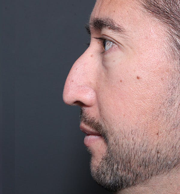 Rhinoplasty Before & After Gallery - Patient 14089519 - Image 5