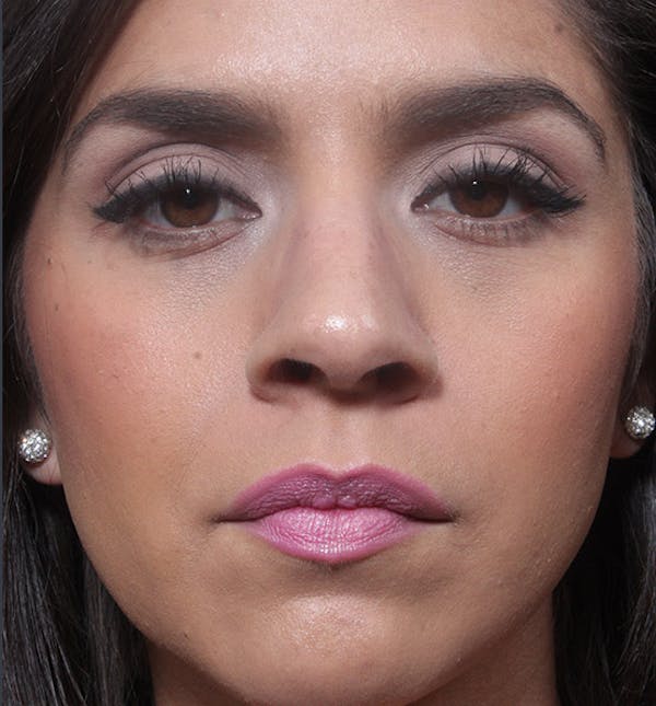 Rhinoplasty Before & After Gallery - Patient 14089522 - Image 3