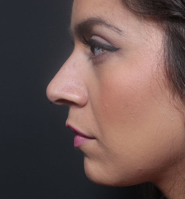 Rhinoplasty Before & After Gallery - Patient 14089522 - Image 5
