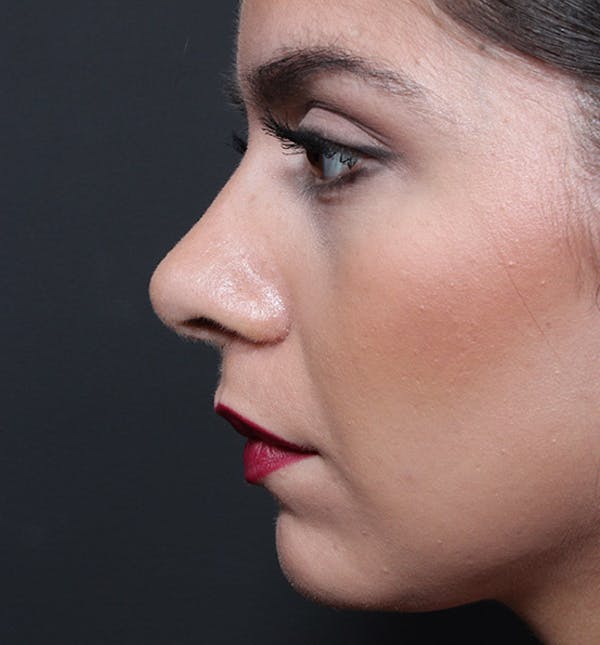Rhinoplasty Before & After Gallery - Patient 14089522 - Image 6