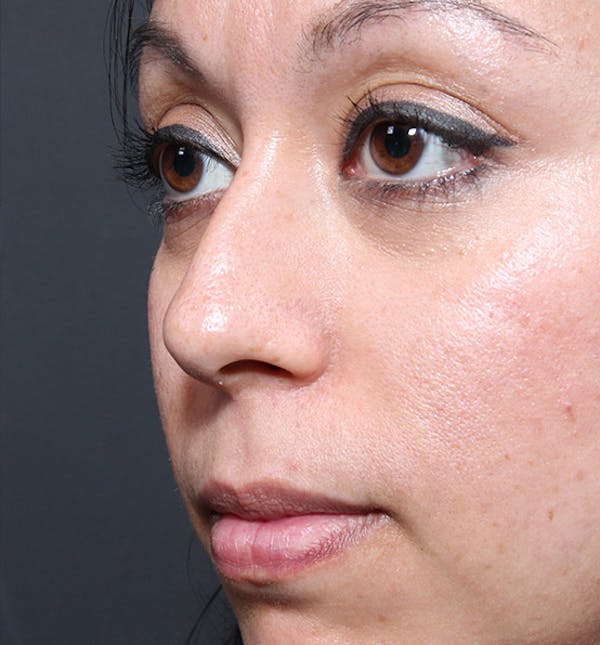 Rhinoplasty Before & After Gallery - Patient 14089523 - Image 1