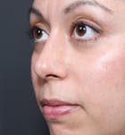 Rhinoplasty Before & After Gallery - Patient 14089523 - Image 2
