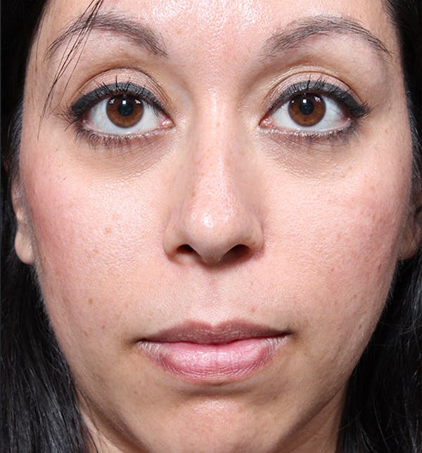 Rhinoplasty Before & After Gallery - Patient 14089523 - Image 3