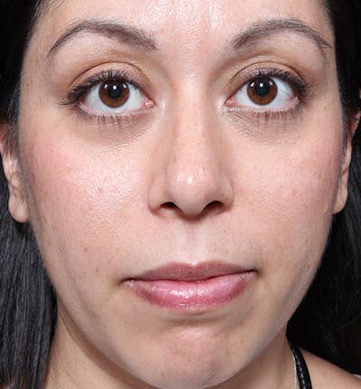 Rhinoplasty Before & After Gallery - Patient 14089523 - Image 4