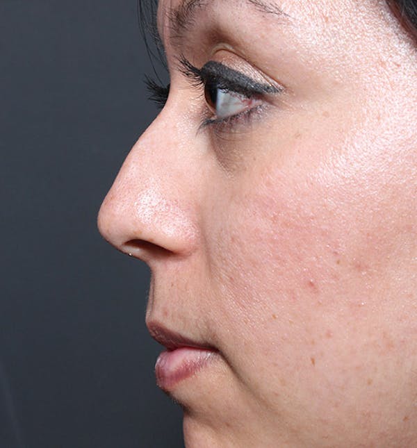 Rhinoplasty Before & After Gallery - Patient 14089523 - Image 5