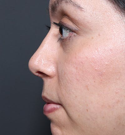 Rhinoplasty Before & After Gallery - Patient 14089523 - Image 6