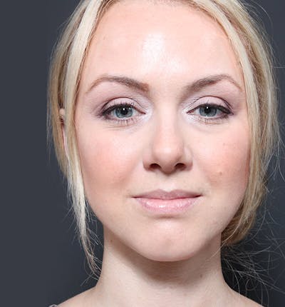 Rhinoplasty Before & After Gallery - Patient 14089524 - Image 4