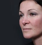 Rhinoplasty Before & After Gallery - Patient 14089527 - Image 1