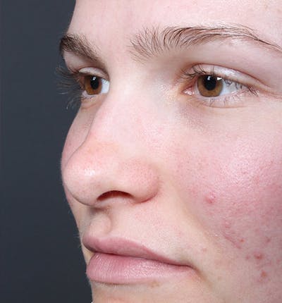 Non-Surgical Rhinoplasty Before & After Gallery - Patient 14089528 - Image 1