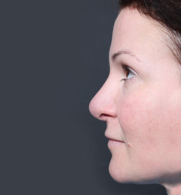 Rhinoplasty Before & After Gallery - Patient 14089527 - Image 6