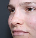 Non-Surgical Rhinoplasty Before & After Gallery - Patient 14089528 - Image 2