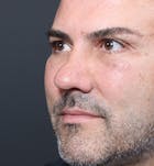 Rhinoplasty Before & After Gallery - Patient 14089530 - Image 1