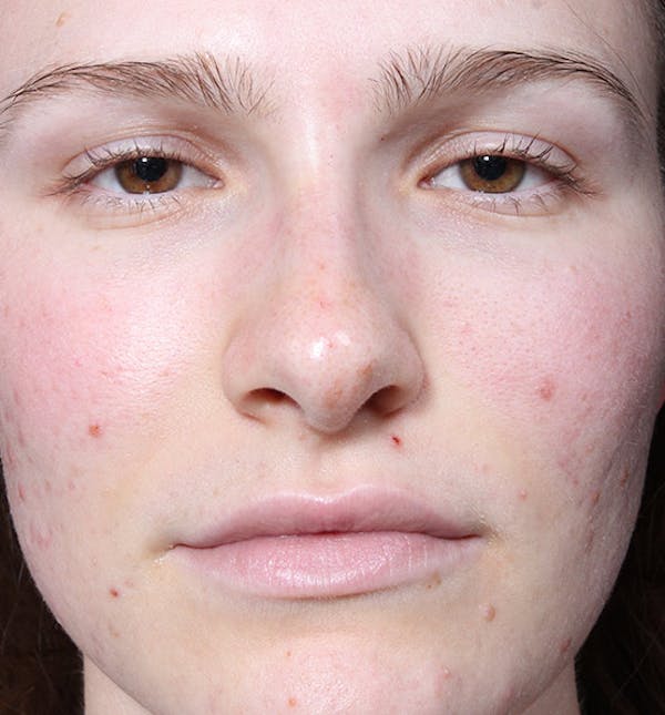 Non-Surgical Rhinoplasty Before & After Gallery - Patient 14089528 - Image 4