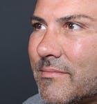 Rhinoplasty Before & After Gallery - Patient 14089530 - Image 2