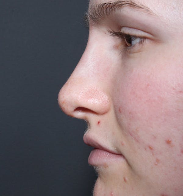 Non-Surgical Rhinoplasty Before & After Gallery - Patient 14089528 - Image 6