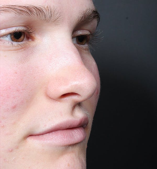 Non-Surgical Rhinoplasty Before & After Gallery - Patient 14089528 - Image 7
