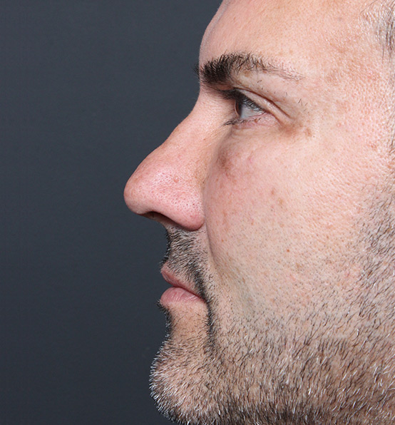 Male Rhinoplasty Patient Before