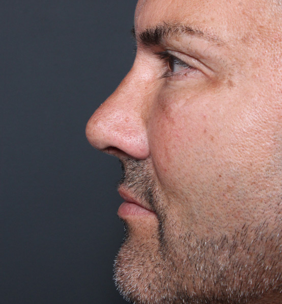 Male Rhinoplasty Patient Before