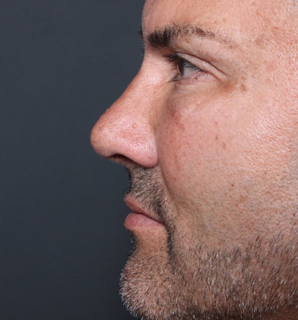 Rhinoplasty Before & After Gallery - Patient 14089530 - Image 6