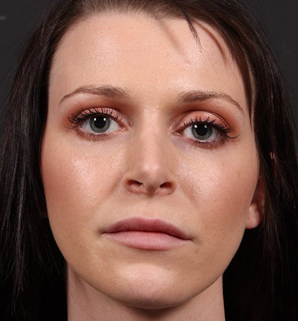 Non-Surgical Rhinoplasty Before & After Gallery - Patient 14089531 - Image 3