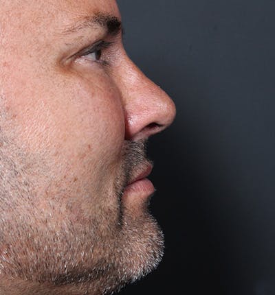 Rhinoplasty Before & After Gallery - Patient 14089530 - Image 10