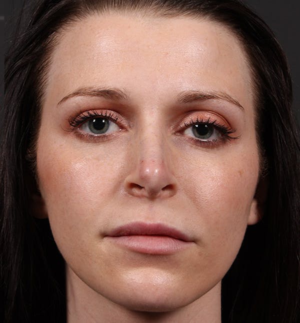 Non-Surgical Rhinoplasty Before & After Gallery - Patient 14089531 - Image 4