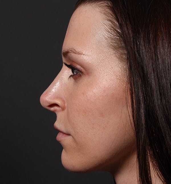 Non-Surgical Rhinoplasty Gallery - Patient 14089531 - Image 5