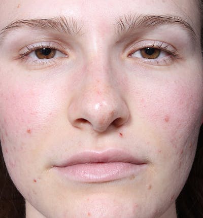 Rhinoplasty Before & After Gallery - Patient 14089533 - Image 4