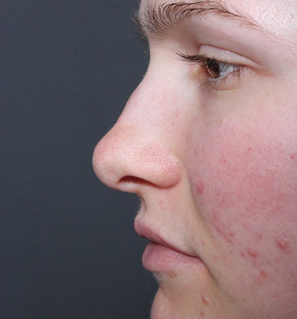 Rhinoplasty Before & After Gallery - Patient 14089533 - Image 5