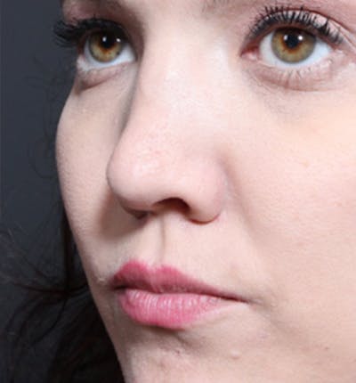 Rhinoplasty Before & After Gallery - Patient 14089536 - Image 1