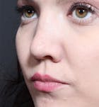 Rhinoplasty Before & After Gallery - Patient 14089536 - Image 1