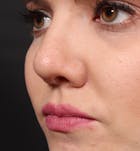 Rhinoplasty Before & After Gallery - Patient 14089536 - Image 2