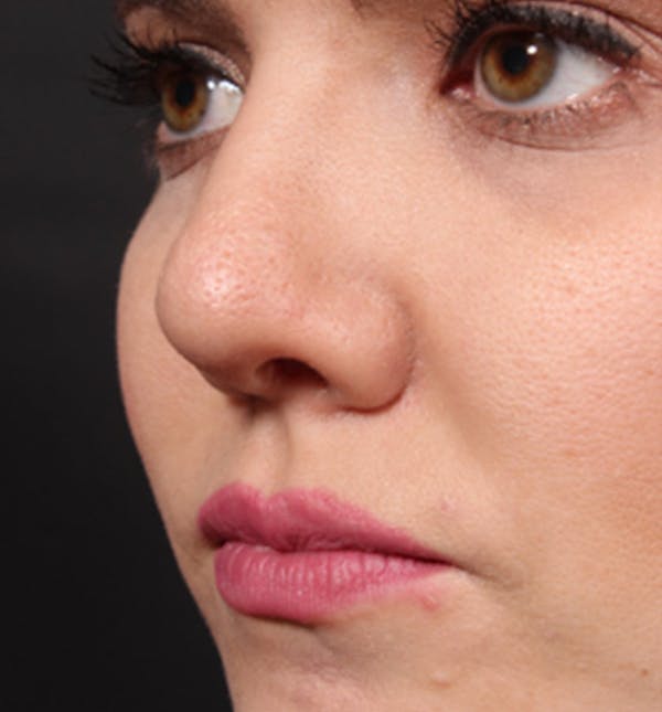 Rhinoplasty Before & After Gallery - Patient 14089536 - Image 2