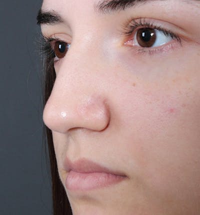 Non-Surgical Rhinoplasty Before & After Gallery - Patient 14089538 - Image 1