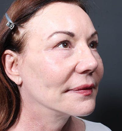 Facelift Before & After Gallery - Patient 14089535 - Image 2