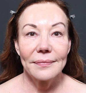 Before and After of Facelift in Scottsdale