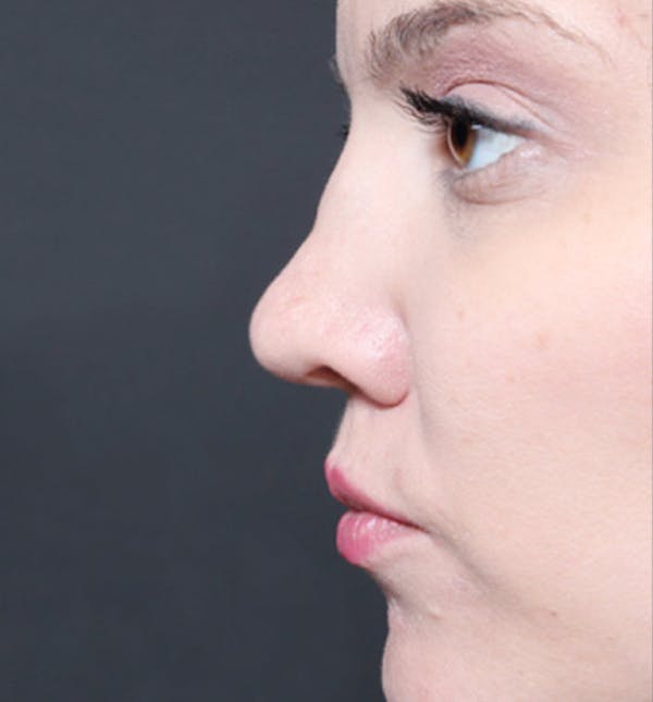 Rhinoplasty Before & After Gallery - Patient 14089536 - Image 5