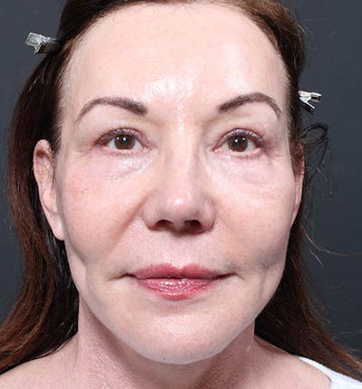Facelift Before & After Gallery - Patient 14089535 - Image 4