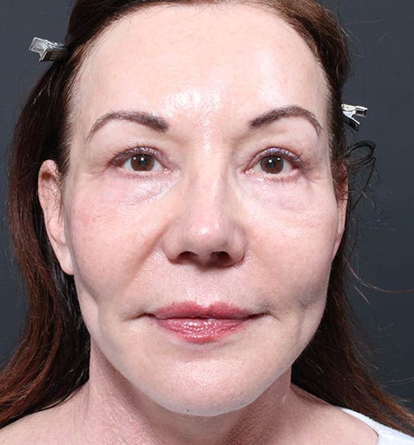 Facelift Before & After Gallery - Patient 14089535 - Image 4