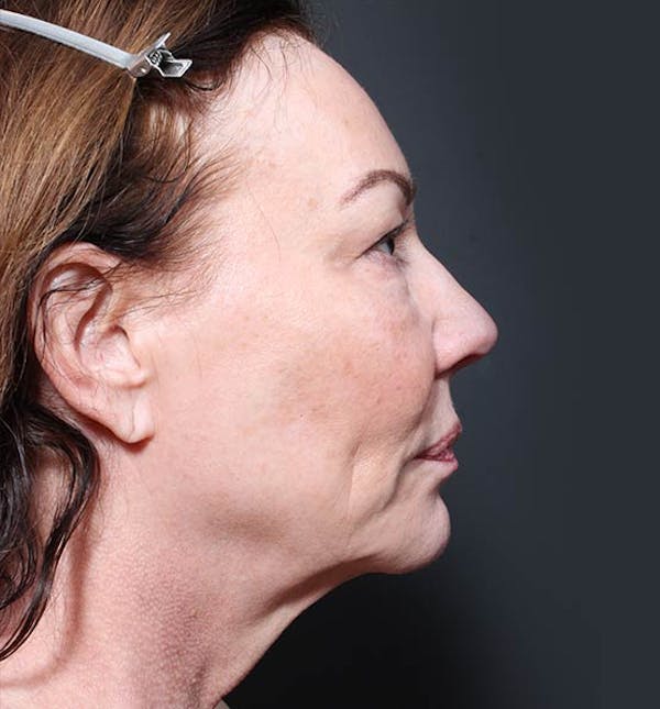 Facelift Before & After Gallery - Patient 14089535 - Image 5
