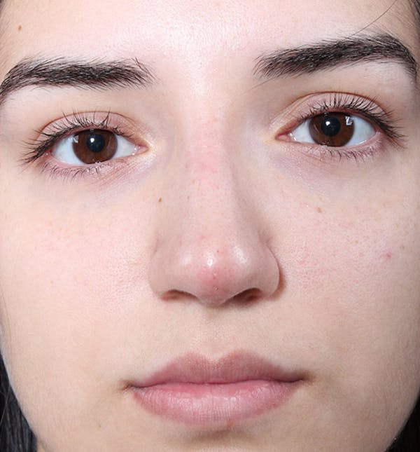 Non-Surgical Rhinoplasty Before & After Gallery - Patient 14089538 - Image 4