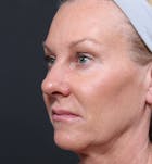 Facelift Before & After Gallery - Patient 14089539 - Image 1