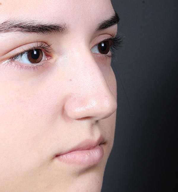 Non-Surgical Rhinoplasty Before & After Gallery - Patient 14089538 - Image 7