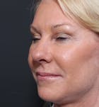 Facelift Before & After Gallery - Patient 14089539 - Image 2