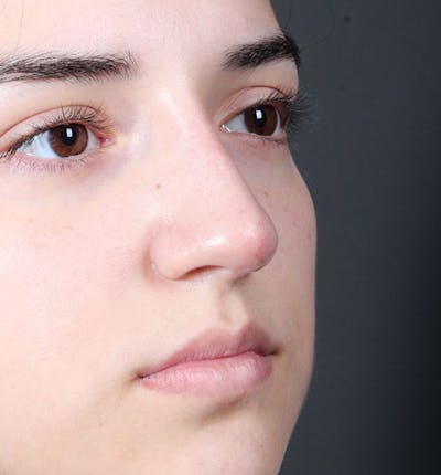 Non-Surgical Rhinoplasty Before & After Gallery - Patient 14089538 - Image 8