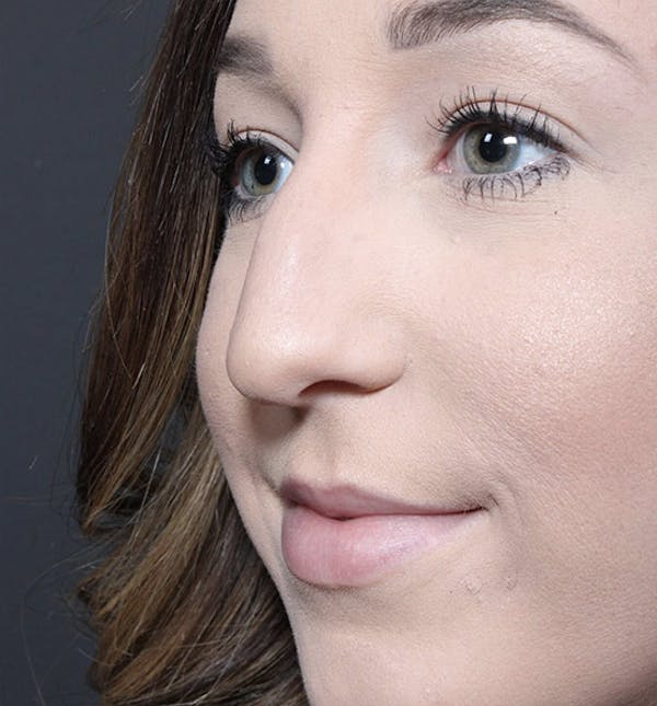 Rhinoplasty Before & After Gallery - Patient 14089540 - Image 1